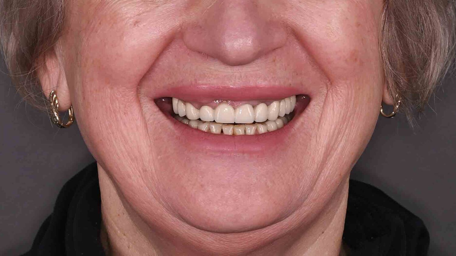 Pacient Clinica Dr. Alin Odor - Rezultat Implantologie
